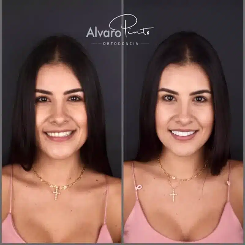 Ortodoncia + Diseño de Sonrisa - Álvaro Pinto Ortodoncia