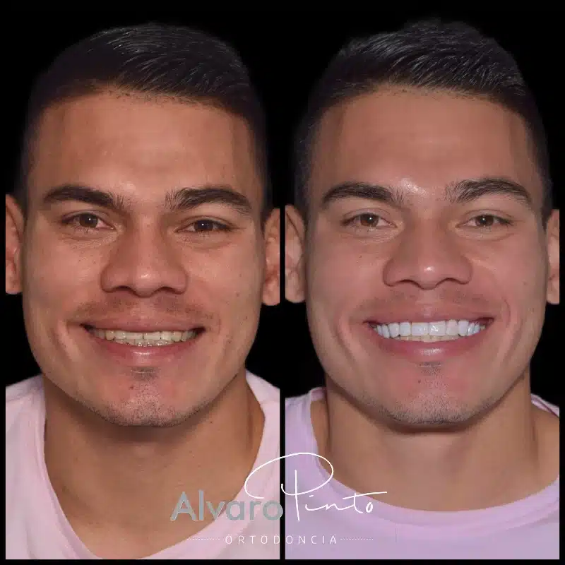 Diseño de Sonrisa y Ortodoncia - Álvaro Pinto Ortodoncia