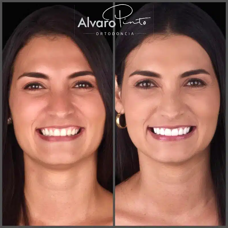 Diseño de Sonrisa Completo - Álvaro Pinto Ortodoncia