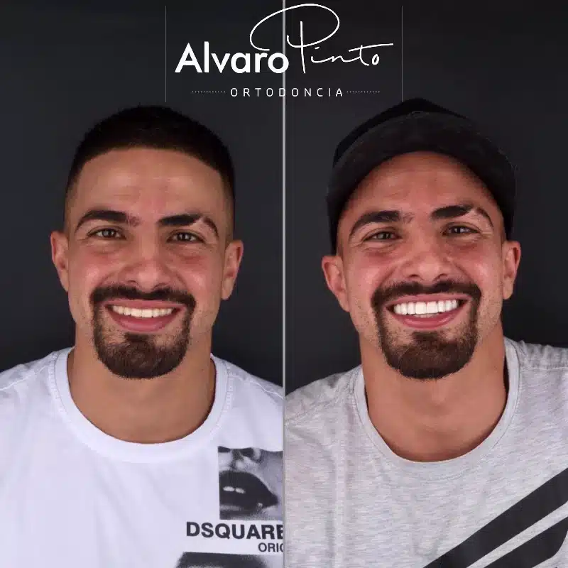 Transformación Facial - Álvaro Pinto Ortodoncia