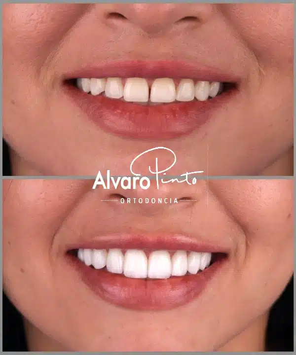 Antes y después tratamiento de blanqueamiento dental - Álvaro Pinto Ibagué, Tolima