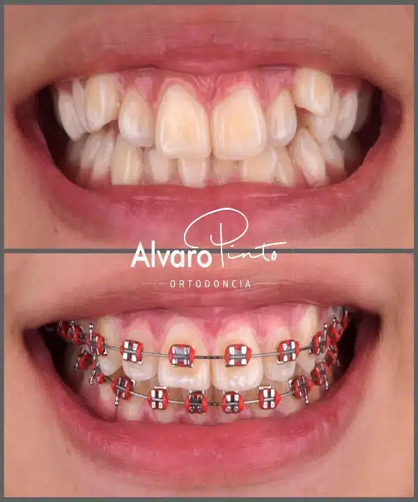 Ortodoncia con brackets metálicos - Inicio de tratamiento Álvaro Pinto Ibagué